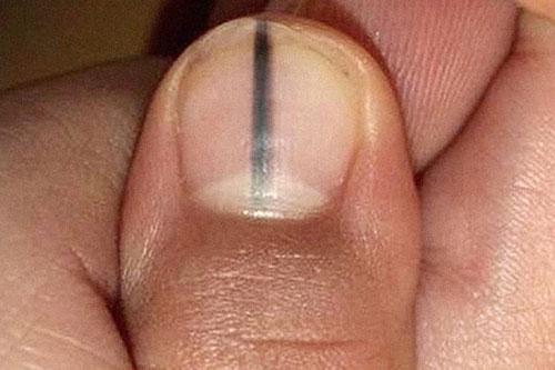 3 bộ phận bị thâm đen chứng tỏ bệnh gan bạn đang ở giai đoạn nặng, chỉ thấy 1 cũng cần đi khám gấp