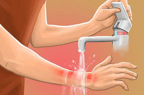 Sai lầm tai hại khi sơ cứu bỏng mà nhiều người vẫn lầm tưởng là đúng