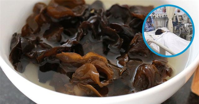 Người phụ nữ tử vong vì một sai lầm khi ăn mộc nhĩ