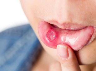 Nhiệt miệng trong mùa hè bạn đã biết cách chữa trị