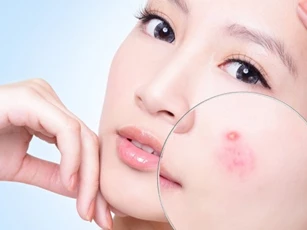 Trị mụn trứng cá hiệu quả cho những nàng lười