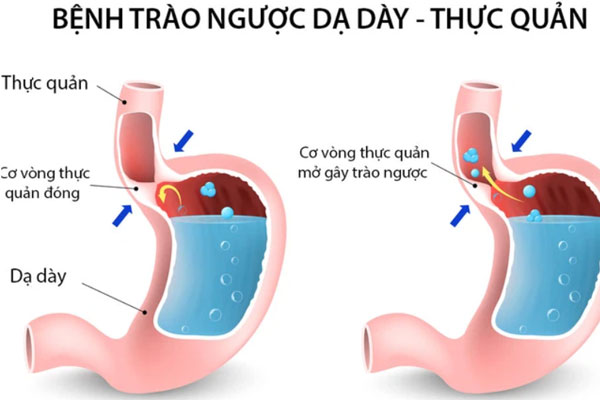 Nhiều người nhầm lẫn hội chứng trào ngược thực quản dạ dày với viêm họng