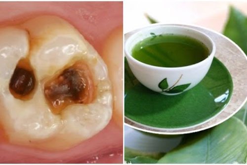 Dùng nước lá chanh đun đặc: Chữa dứt điểm viêm lợi, sâu răng ê buốt, hôi miệng lâu năm