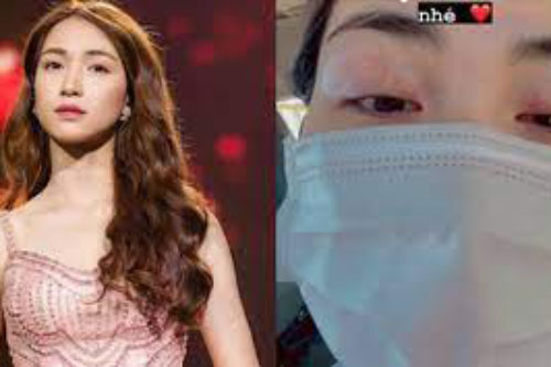 Hòa Minzy bất ngờ đăng ảnh cận đôi mắt sưng vù và đỏ hoe đáng lo lắng, chuyện gì đây?