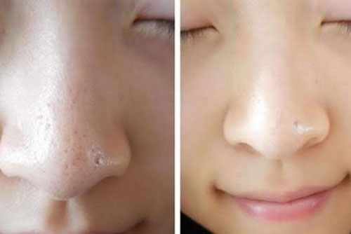 Khắc phục tình trạng lỗ chân lông to hiệu quả
