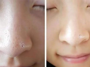 Khắc phục tình trạng lỗ chân lông to hiệu quả