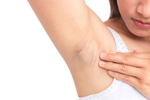 4 nguyên liệu trong bếp giúp nách hết thâm đen