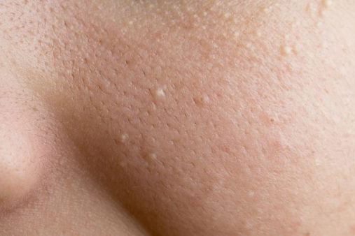 2 cách trị mụn đầu trắng bạn chưa biết