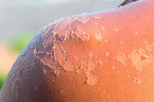 Bỏng da do cháy nắng xử lý thế nào?