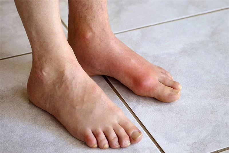 Cách giúp bạn phòng chống bệnh gout