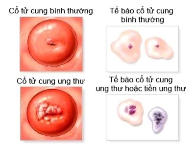 dau-hieu-benh-ung-thu-co-tu-cung