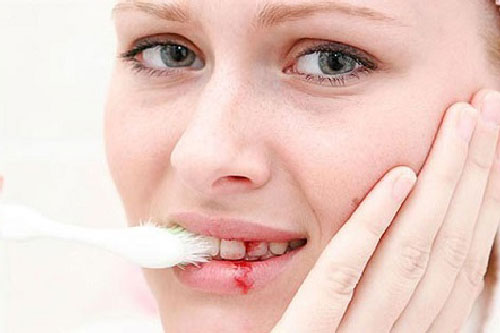 Chảy máu chân răng là dấu hiệu nhiều bệnh nguy hiểm