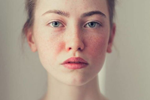 Cần làm gì khi làn da xuất hiện các đốm sắc tố?