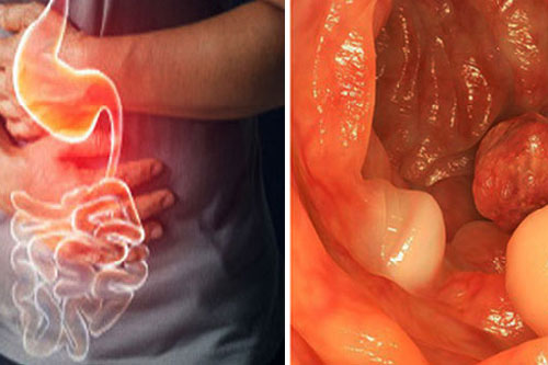 Dấu hiệu '2 đau, 1 nhiều' chứng tỏ ruột đang bệnh nặng, cẩn thận ung thư 'gõ cửa'
