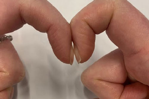 Đặt 2 đầu ngón tay trỏ sát nhau, có thể đoán ngay mình có bị ung thư phổi hay không