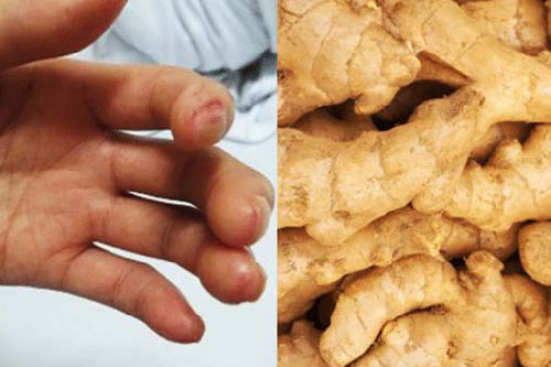 Bài thuốc từ gừng trị dứt điểm tê bì chân tay, nhức mỏi, châm chích mấy cũng khỏi hẳn