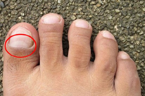 3 dấu hiệu trên bàn chân báo hiệu nôi tạng đang suy kiệt, nên đi khám ngay còn kịp