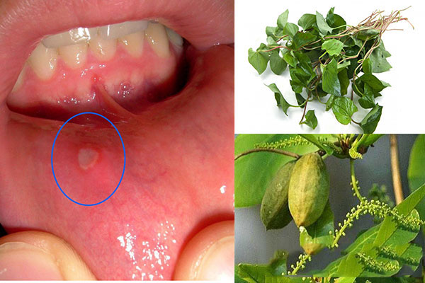 4 cách chữa nhiệt miệng bằng dân gian hiệu quả tức thì mà không hại sức khỏe