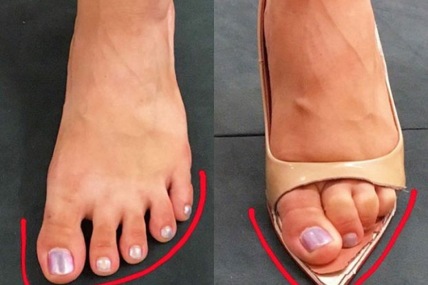 Những đôi chân biến dạng vẹo vọ, xấu xí và đau đớn vì đam mê đi giày cao gót của các sao