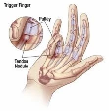 Lướt điện thoại, máy tính ngày đêm, dễ có ngày mắc bệnh ở tay đau đớn mãi không chữa khỏi 3