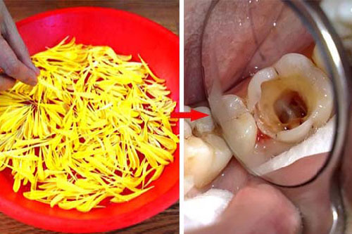 Chữa dứt điểm sâu răng, đau nhức răng bằng loại nguyên liệu 'với tay là có' sau 7 ngày