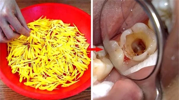 Chữa dứt điểm sâu răng, đau nhức răng bằng loại nguyên liệu 'với tay là có' sau 7 ngày 0