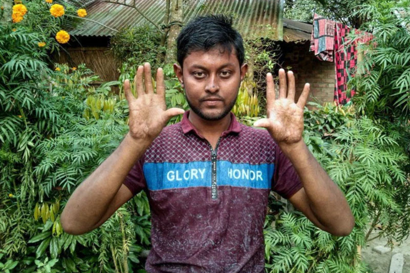 Kỳ lạ tình trạng không có vân tay của 4 thế hệ trong cùng một gia đình