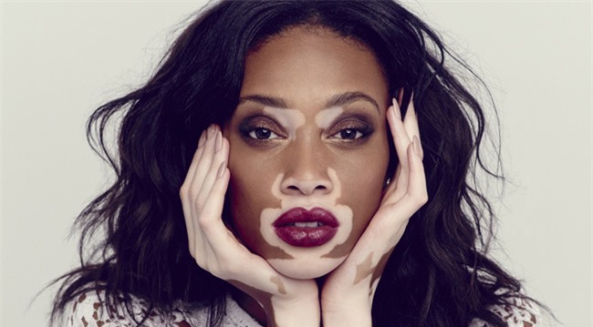 Những hội chứng khiến người bệnh sở hữu vẻ ngoài kỳ dị "có 1 không 2"