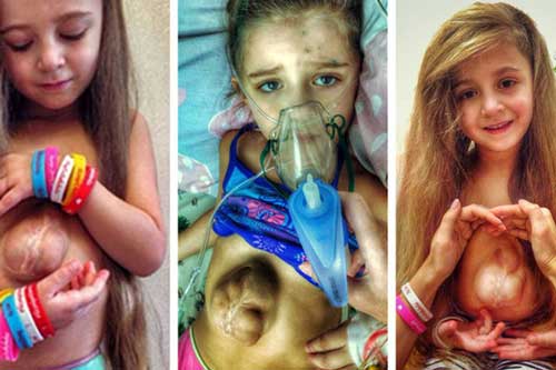 Có trái tim nằm ngoài lồng ngực cực kỳ hiếm gặp, bé gái vừa ra đời đã được gọi là "phép màu y học" giờ thế nào?