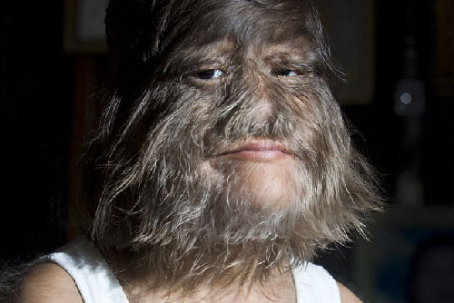 Cô bé "người sói" với khuôn mặt nhiều lông lá nhất thế giới sau hơn 10 năm xuất hiện trở lại với vẻ ngoài cùng cuộc sống gây kinh ngạc