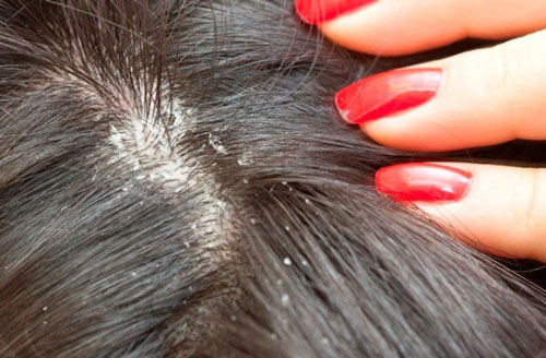 Trị gàu trong mùa hè hiệu quả với muối