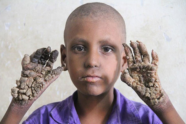 20 căn bệnh kỳ lạ, hiếm gặp nhất trên thế giới: Người cây, đầu tự phát nổ...