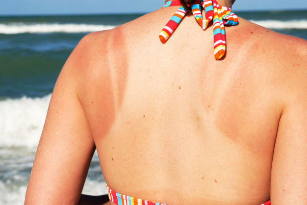 4 điều cần làm để cứu nguy cho làn da bị cháy nắng