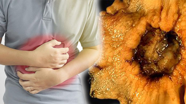 Ung thư dạ dày từ món ăn ‘sở trường’, 90% người Việt đều mắc phải sai lầm khi ăn món này