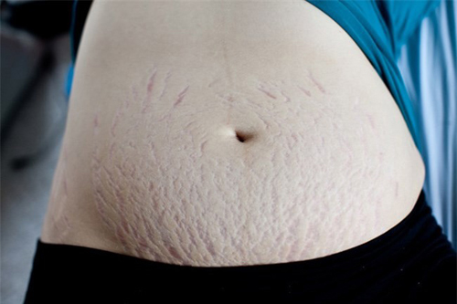 Công thức chữa rạn da bà bầu cần nhớ