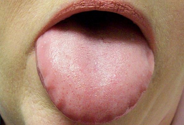 Lưỡi có biểu hiện này coi chừng bệnh đau dạ dày