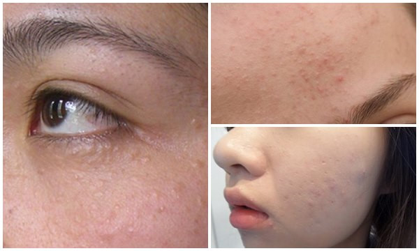 Cách điều trị mụn ẩn tại nhà đơn giản bạn cần nhớ