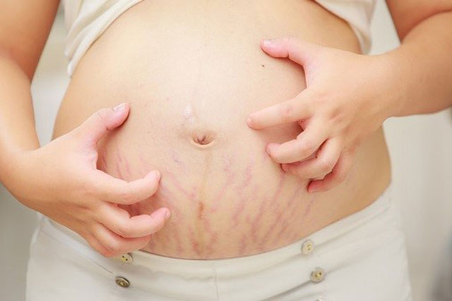 Cách chữa rạn da tại nhà an toàn và hiệu quả