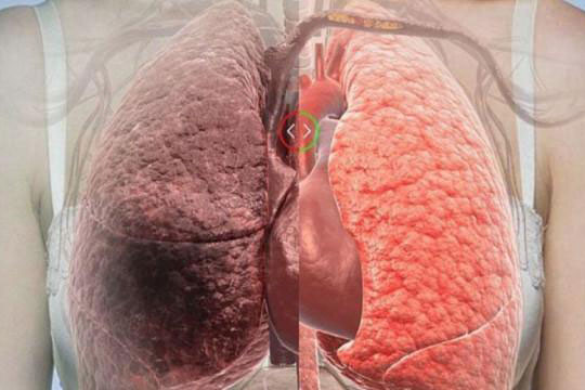 'Chỉ mặt' nguyên nhân gây ung thư phổi ngay hôm nay