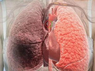 'Chỉ mặt' nguyên nhân gây ung thư phổi ngay hôm nay