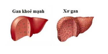 Gan nhiễm mỡ có thể gây ra xơ gan nếu không được xử lý kịp thời.