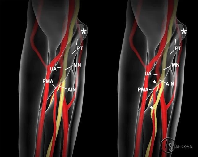 Loài người vẫn đang tiếp tục tiến hóa, bạn có thể có thêm một động mạch trong cơ thể và nó đang phát triển rất nhanh chóng - Ảnh 1.