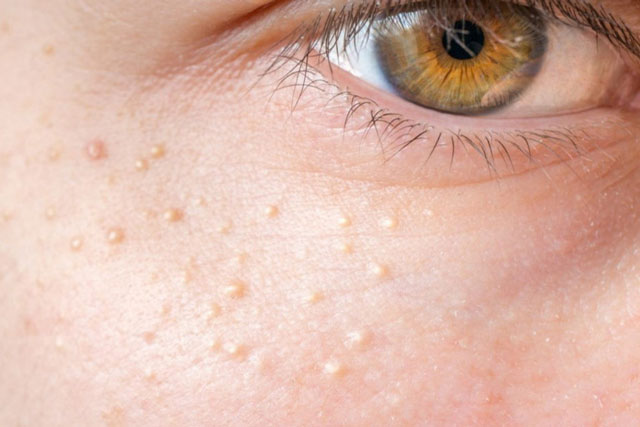 3 cách trị mụn thịt mà không tốn tiền