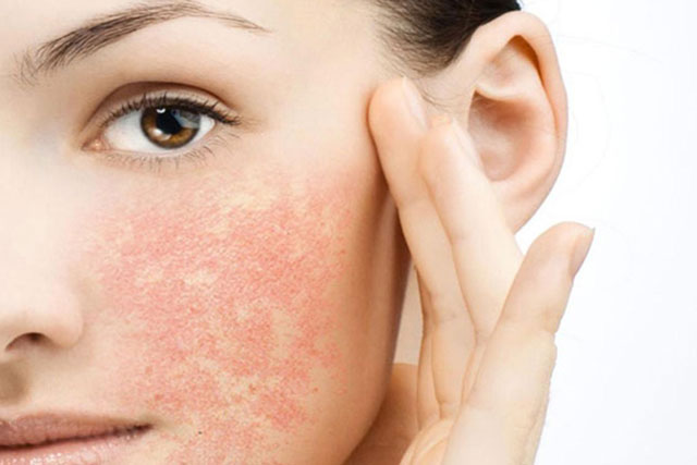 Dấu hiệu nhận biết làn da nhạy cảm