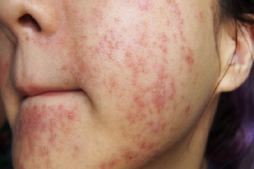 Mụn chi chít vì thói quen tưởng chừng như vô hại