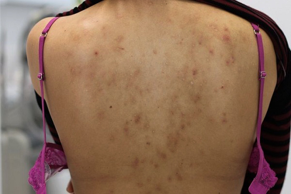 4 cách trị mụn ở lưng, ai cũng nên biết