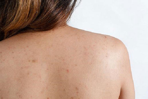 Sạch mụn ở lưng chỉ với 3 nguyên liệu ai cũng kiếm được