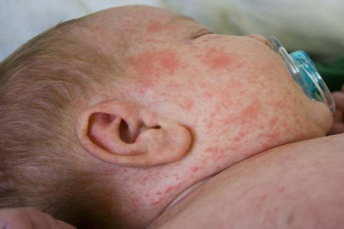 3 mẹo dân gian giúp bạn trị rôm sảy cho bé trong mùa hè