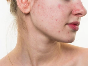 5 vấn đề về da bạn thường gặp phải trong mùa hè