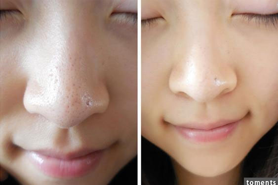 3 cách trị mụn đầu đen tại nhà cực nhanh